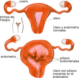 Pólipos uterinos - IMFER MURCIA